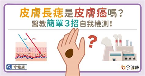 身體長誌|皮膚長痣是皮膚癌嗎？醫教簡單3招自我檢測！